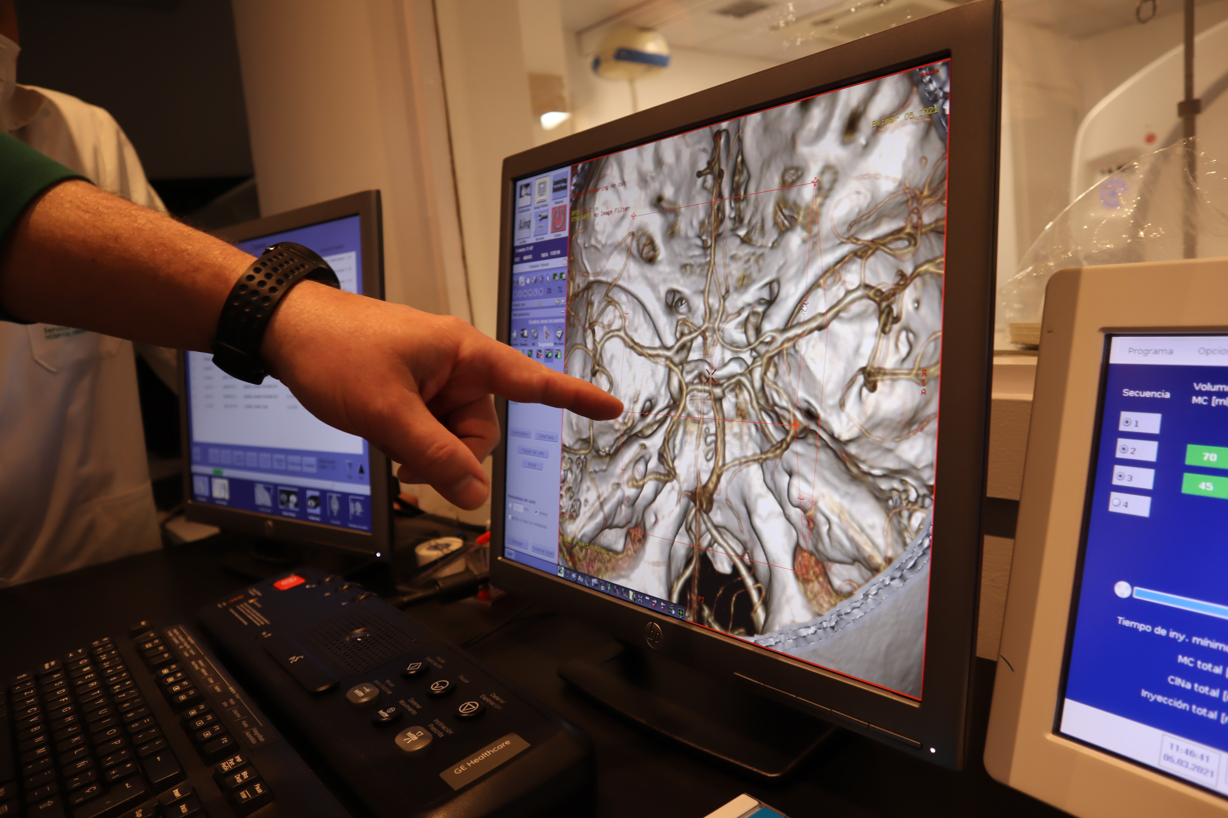 El Hospital Virgen de las Nieves instala un nuevo equipo TAC en el área de Neurorradiología